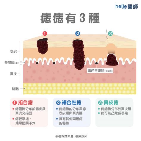 臉上長很長的毛|痣變大、痣多或長毛會變皮膚癌？認識痣的形成與原因